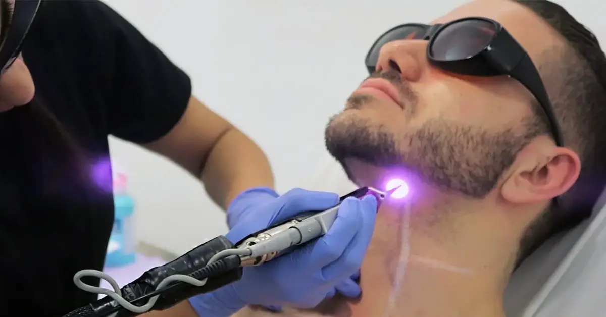 Cynosure Apogee Elite laser used for men’s hair removal treatments