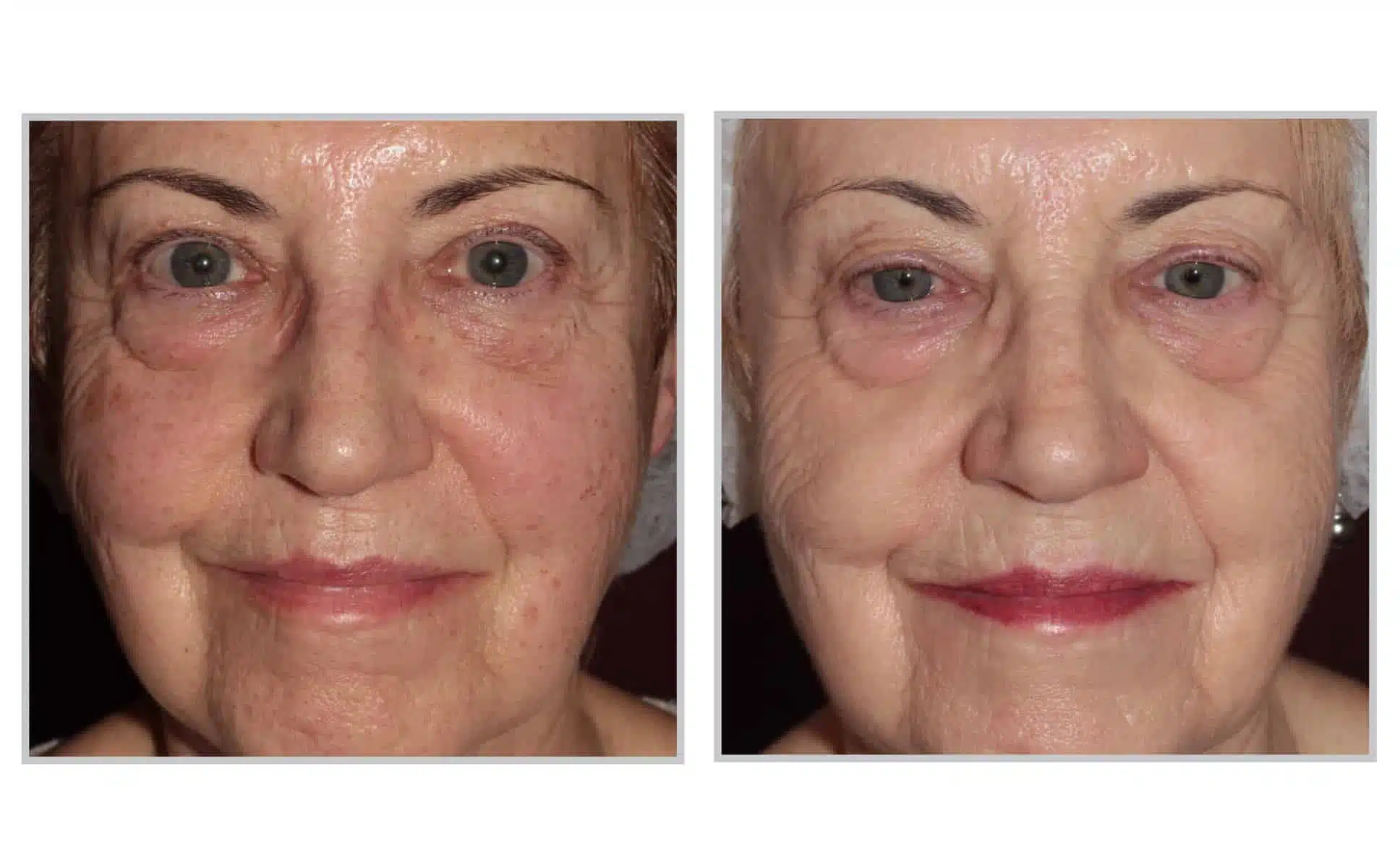Sciton BBL skin rejuvenation result