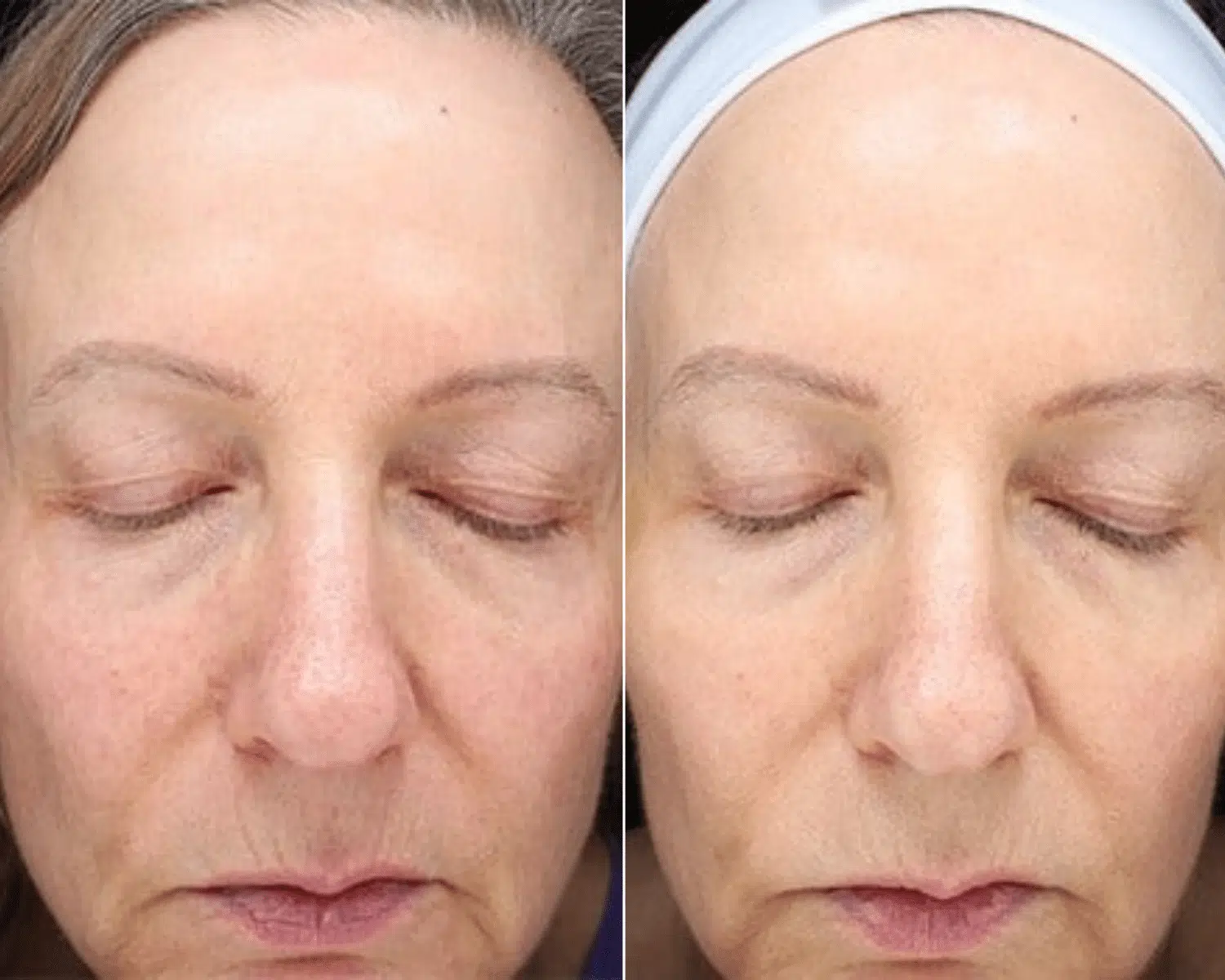 SkinTyte BBL before and after treatment comparison
